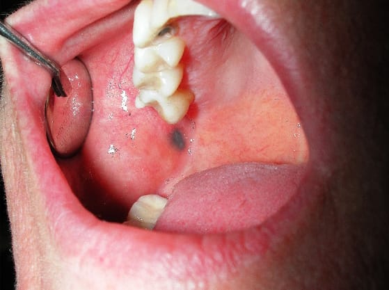 Pigmented Lesions of the Oral Mucosa | SpringerLink
